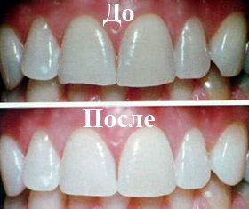 чистка зубов до и после
