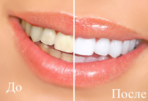 чистка зубов фото до и после